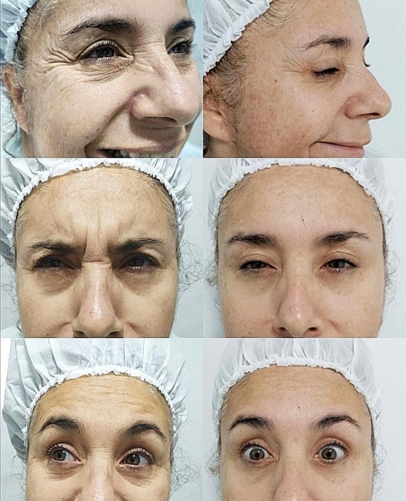 Botox