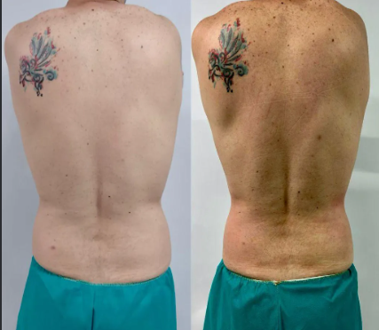Hidrolipoclasia