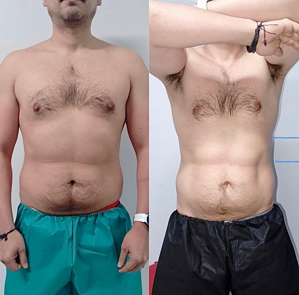 Hidrolipoclasia