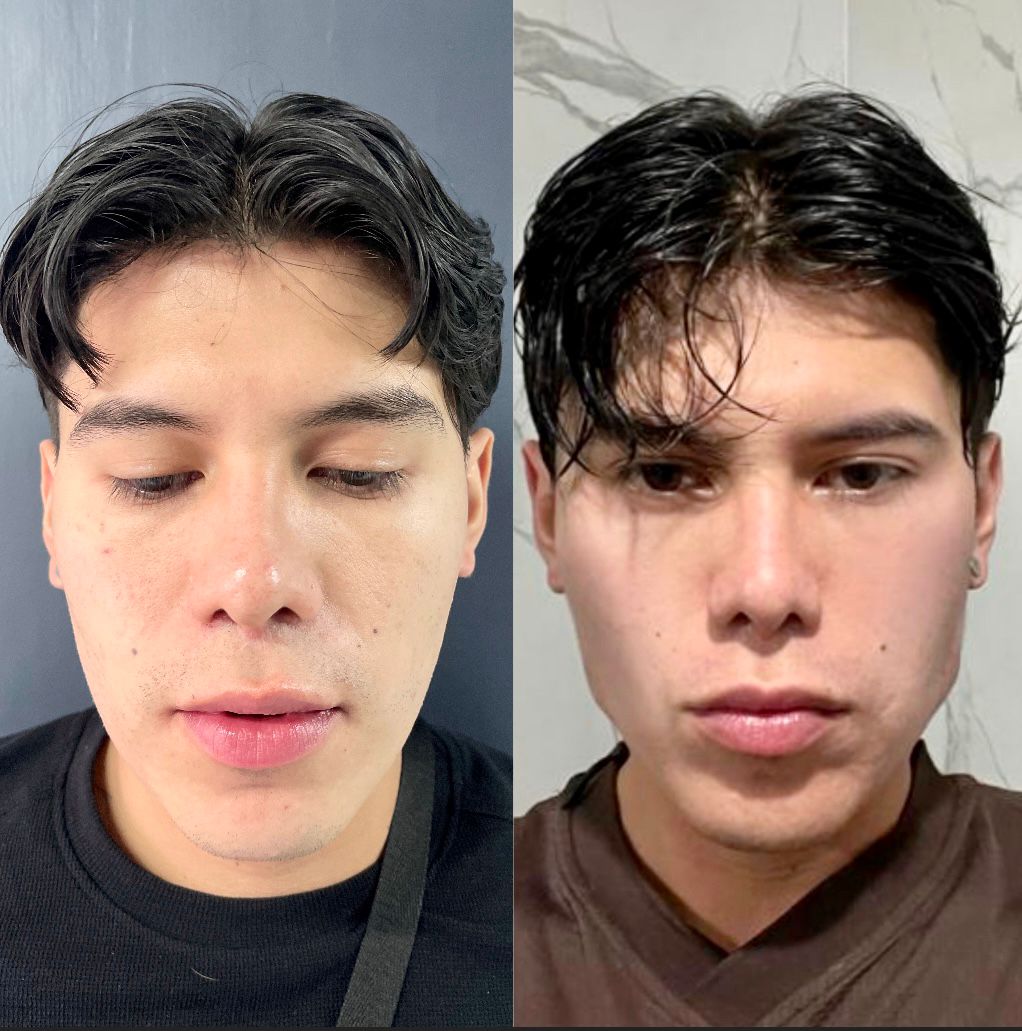 Masculinización Facial
